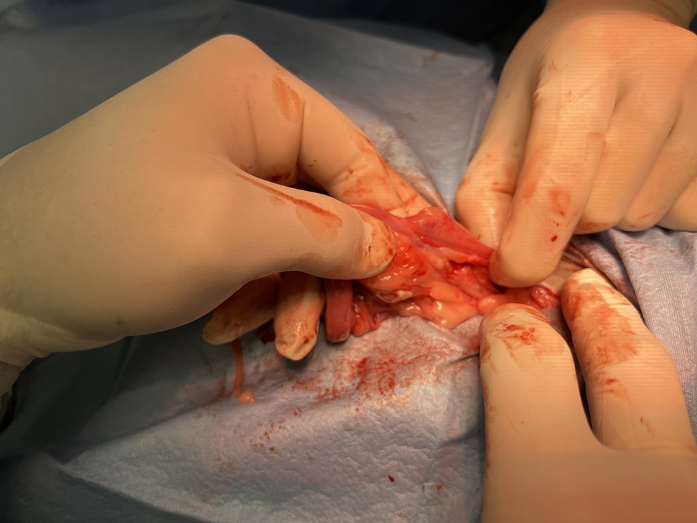 ovarian ligament