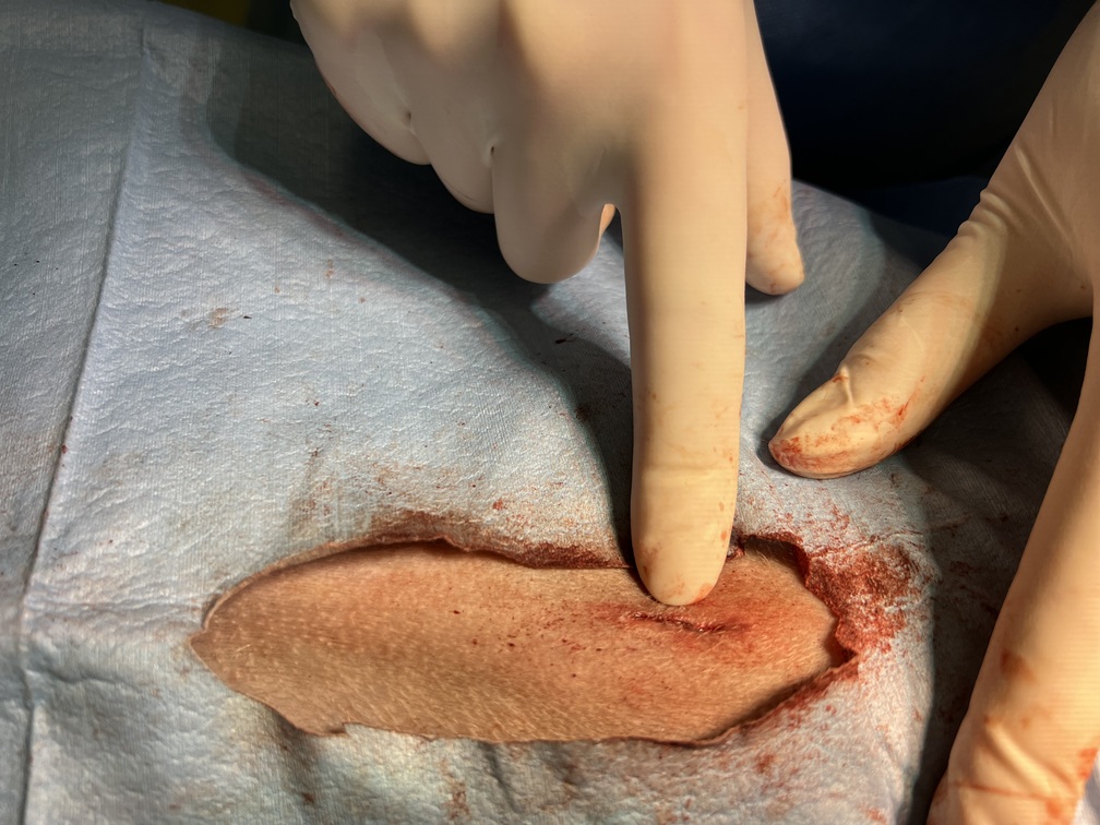 mini wound  sterilisation